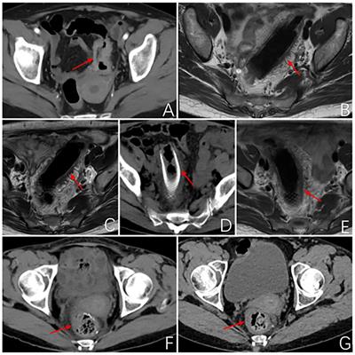 Case report: A clinical report of photodynamic neoadjuvant combined with fluorescent laparoscopic localization robotic surgery for the treatment of patients with advanced colorectal cancer combined with obstruction